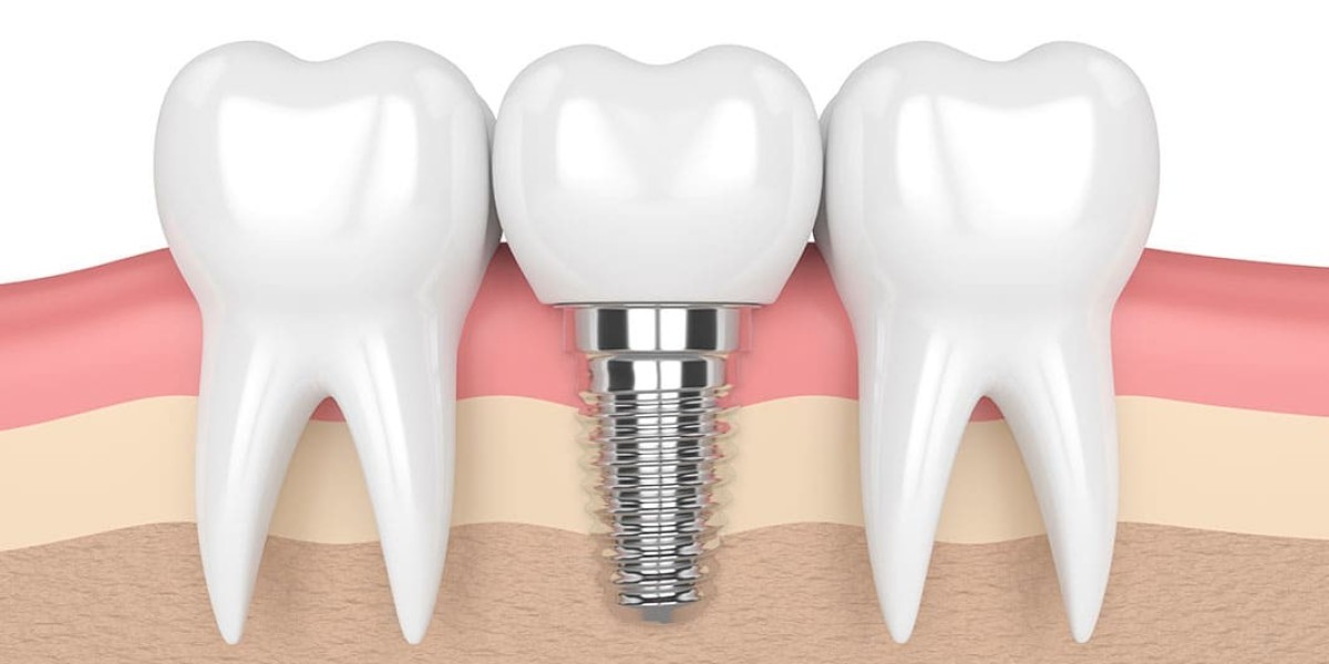 Dental Implants Offer a Permanent Path to Your Dream Smile