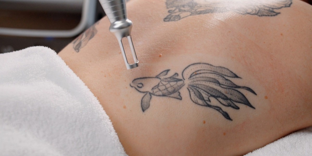 Laser Tattoo Removal: The Non-Surgical Option for Tattoo Erasure