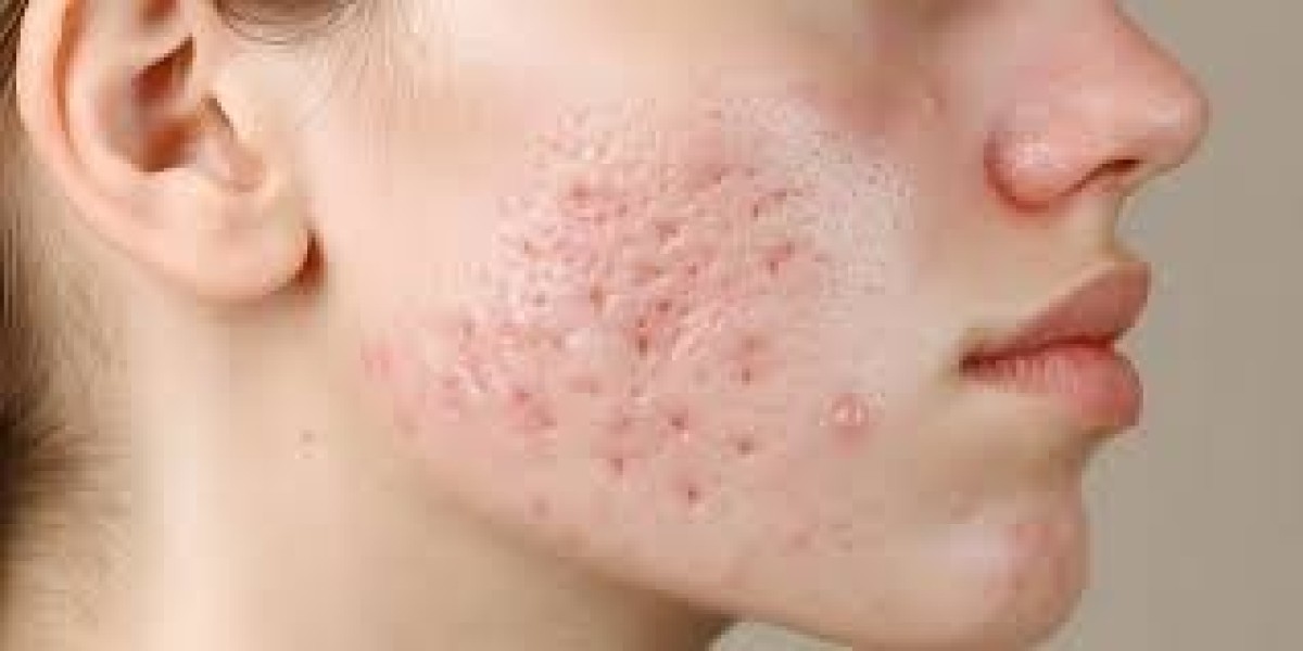 Acne Scar Treatment for Long-Term Skin Health