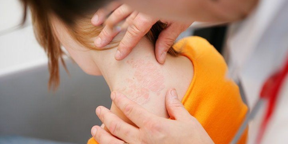 Best Dermatologist For Eczema Relief
