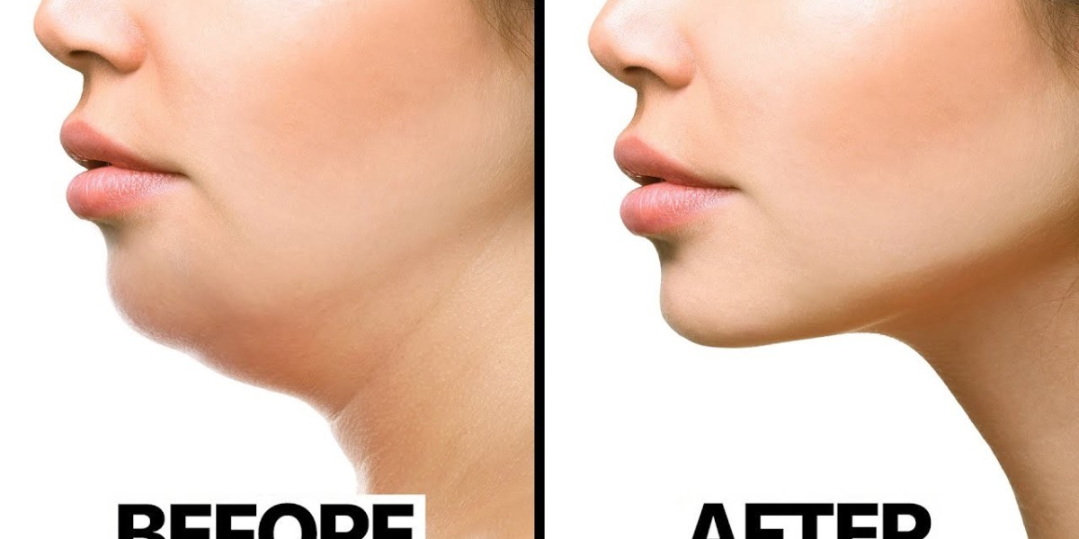 Radiofrequency Treatments for Chin Fat in Riyadh