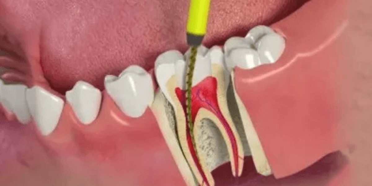 Trám răng sâu có lấy tủy không? Giải đáp từ chuyên gia nha khoa