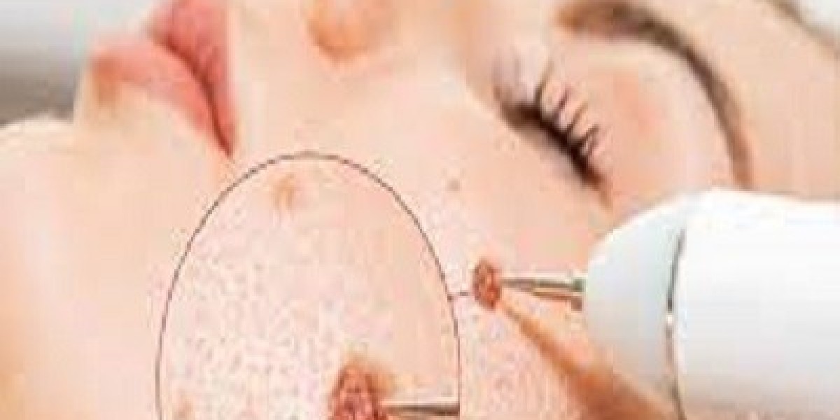 Why Do Warts Appear and How Can You Prevent Them?