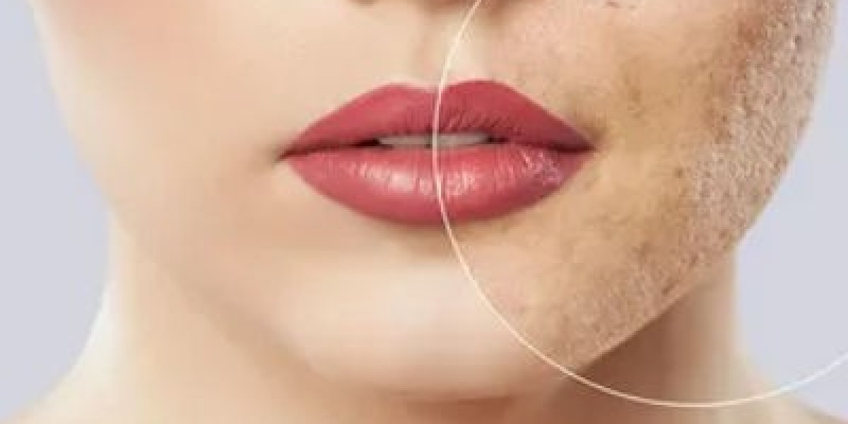 The Impact of Stress on Acne Scars and Their Treatment in Islamabad