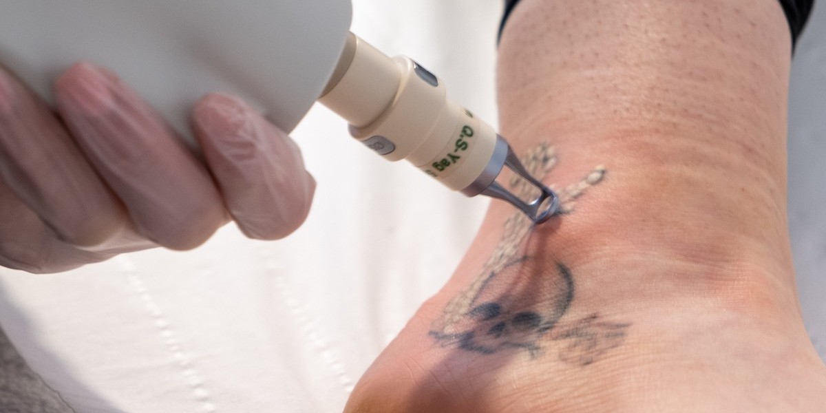 The Secret to Ink-Free Skin Is Laser Tattoo Removal