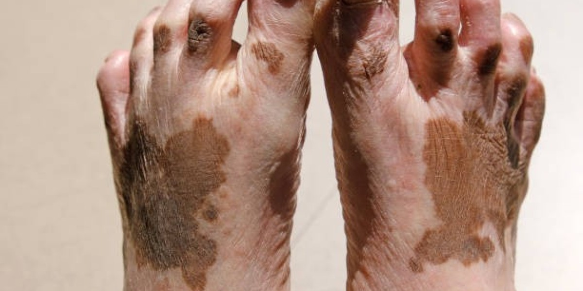 Dr. Vishal Patel Treatment of Vitiligo in Mumbai