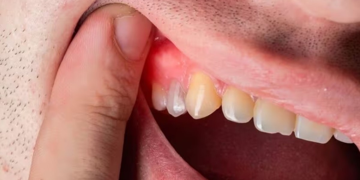 Biến chứng sau khi nhổ răng khôn: Cảnh báo và cách xử lý đúng cách