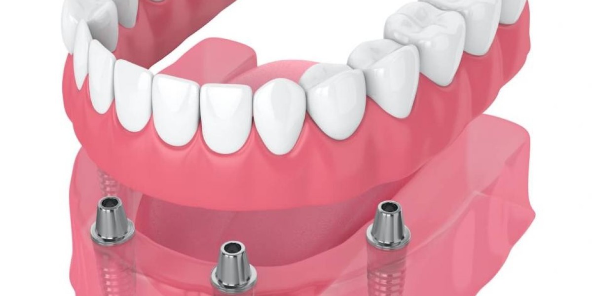 Full Mouth Dental Implants Cost Checklist Before You Commit