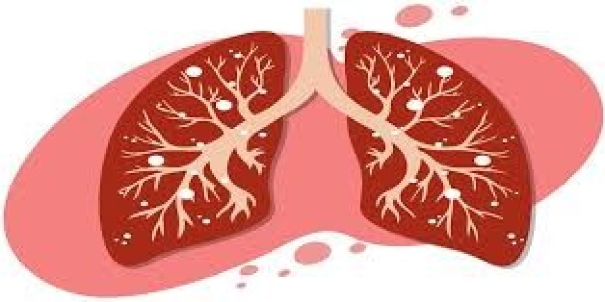 Bronchitis Treatment Market Outlook 2021–2030: Growth, Forecast, and Regional Insights