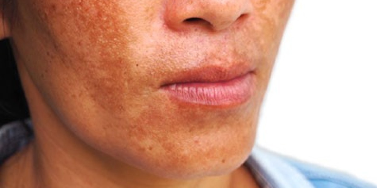 Effective Sunscreens to Prevent Melasma in Intense Sun
