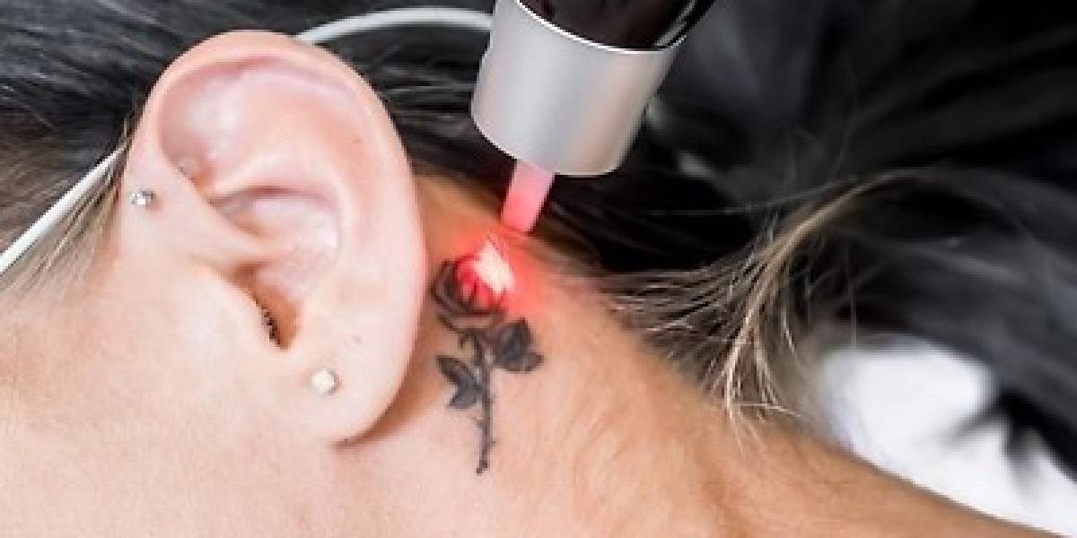 How Laser Tattoo Removal Works: A Complete Guide