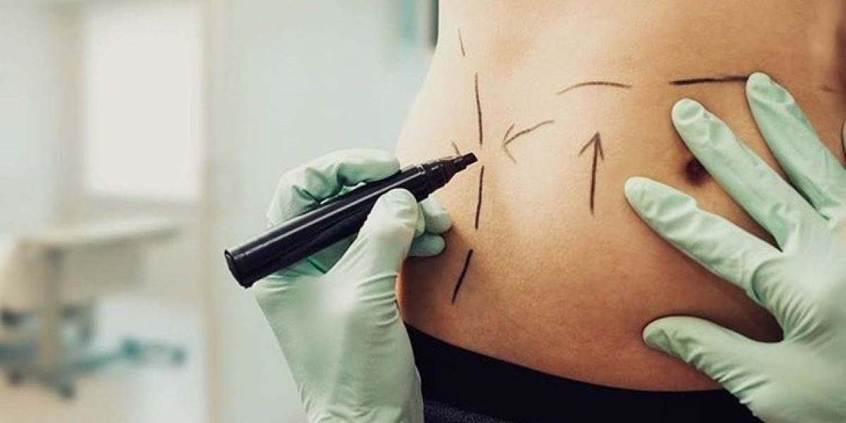 When Can I Resume Exercise After Liposuction?