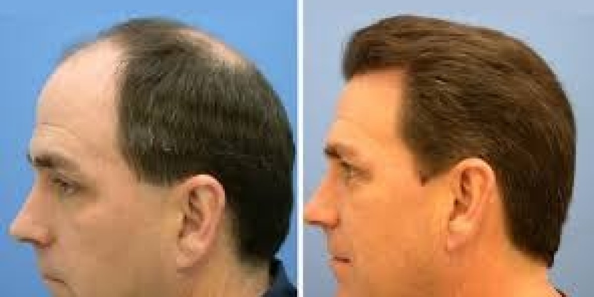 مقارنة بين تكلفة زراعة الشعر في تركيا ودبي: أيهما الأفضل لك؟