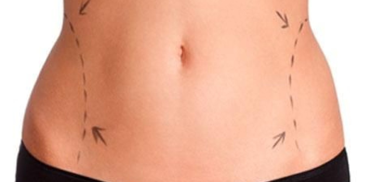 The Complete Guide to Tummy Tuck in Riyadh – What You Need to Know