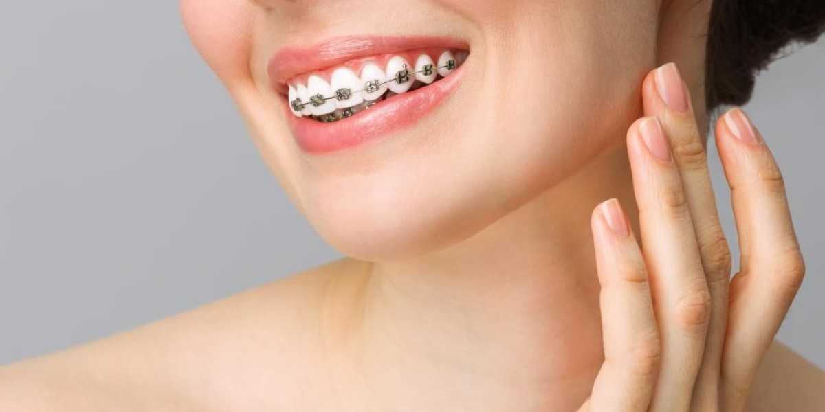 Top 5 Fun Brace Colors and What They Say About You