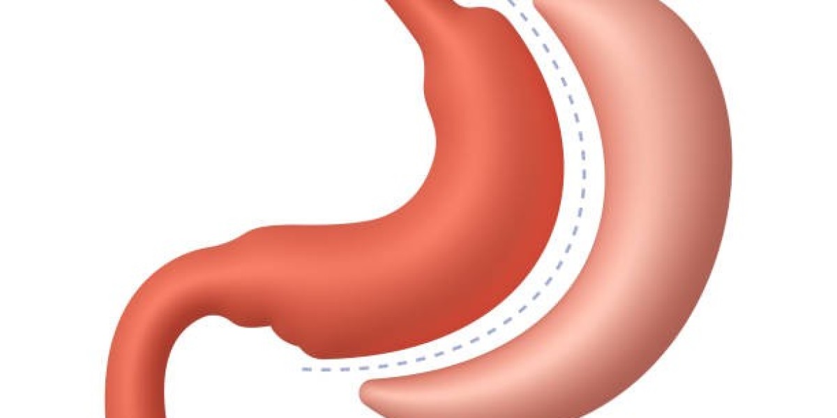 Get Back in Shape with Bariatric Surgery Riyadh