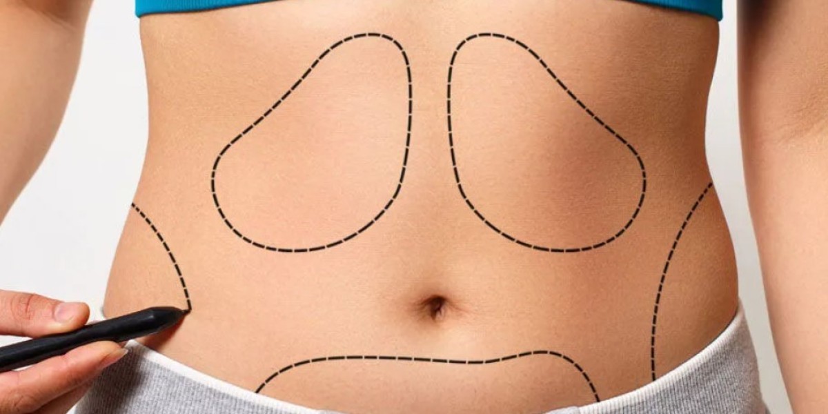 Preparing for Liposuction Surgery in Riyadh: A Step-by-Step Guide