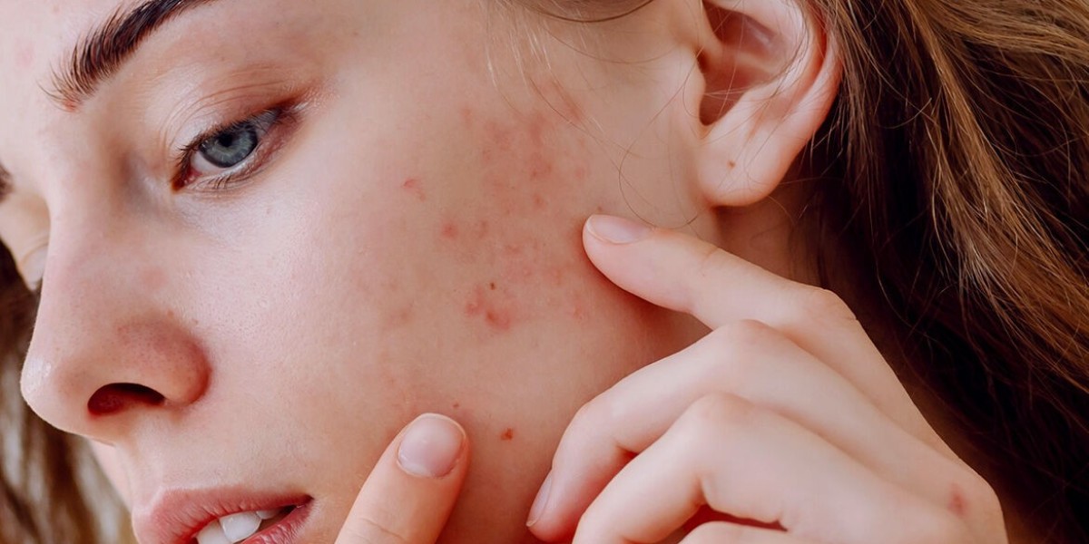 Clearer Skin Naturally: Your Guide to Beating Acne Without Harsh Chemicals