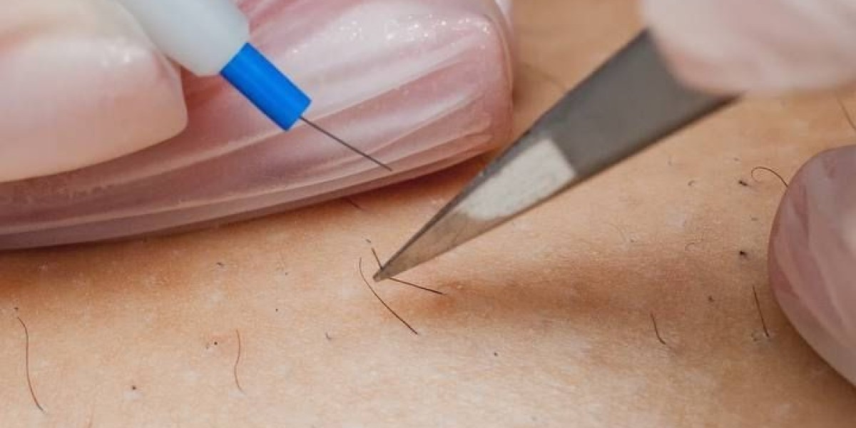 Electrolysis Surgery in Riyadh: Skin-Safe Methods