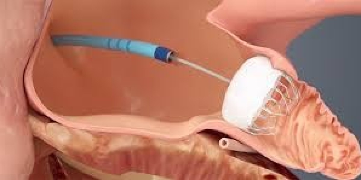 Atrial Fibrillation Device Market Innovations: Paving the Future of Cardiac Care