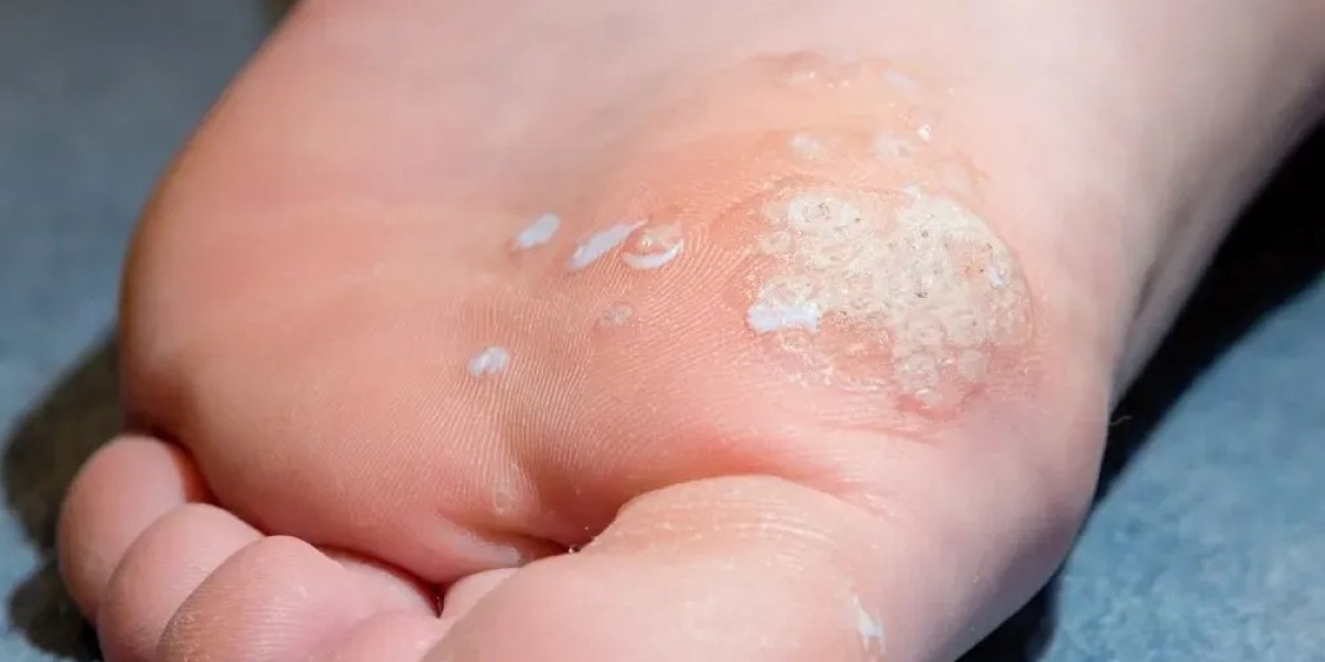 The Truth About How Salicylic Acid Helps Remove Warts