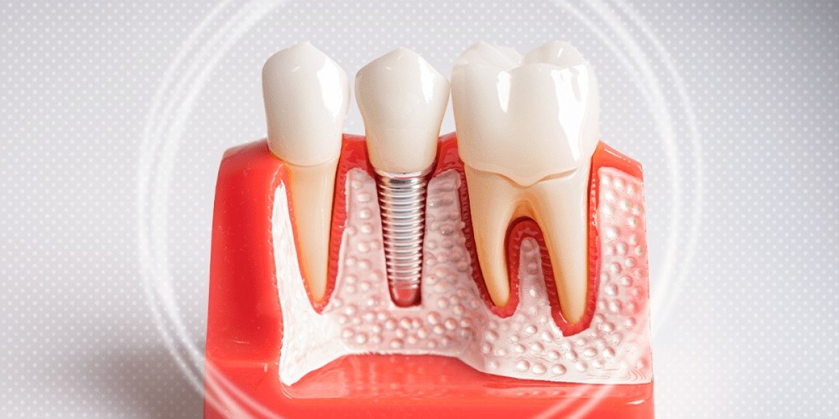 Get Back to Living Fully with Dental Implants