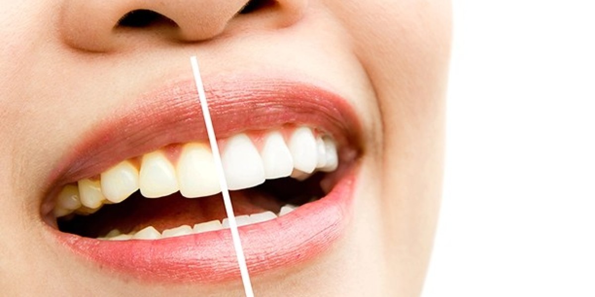Looking for Dental Whitening Near Me? Discover Radiant Smiles at Serena Medical Center