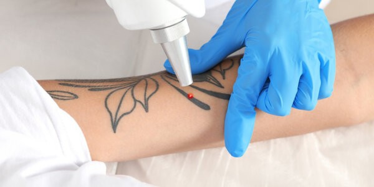 Laser Tattoo Removal in Riyadh: Pain Level and Recovery Tips