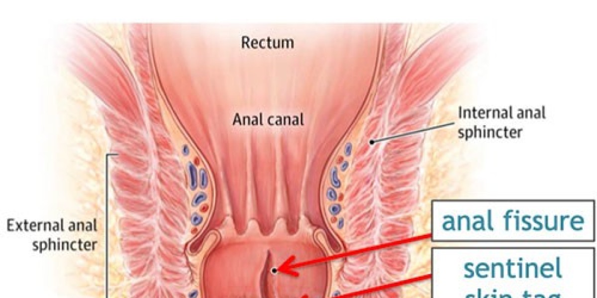 Advanced Fissure Treatment Options in Bangalore: Consult Dr. Bhushan Chittawadagi Today