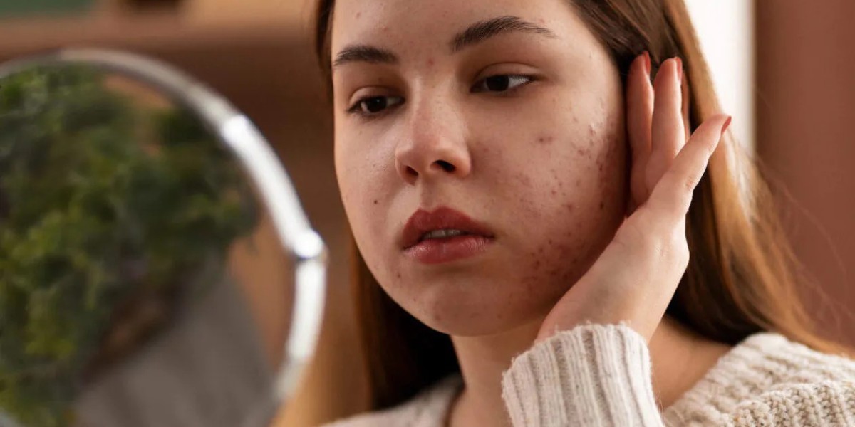 Say Goodbye to Breakouts with Safe Acne Treatment Options