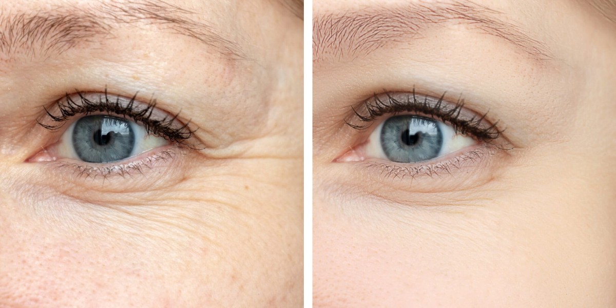 Hydrafacial for Wrinkles: Where to Go in Riyadh