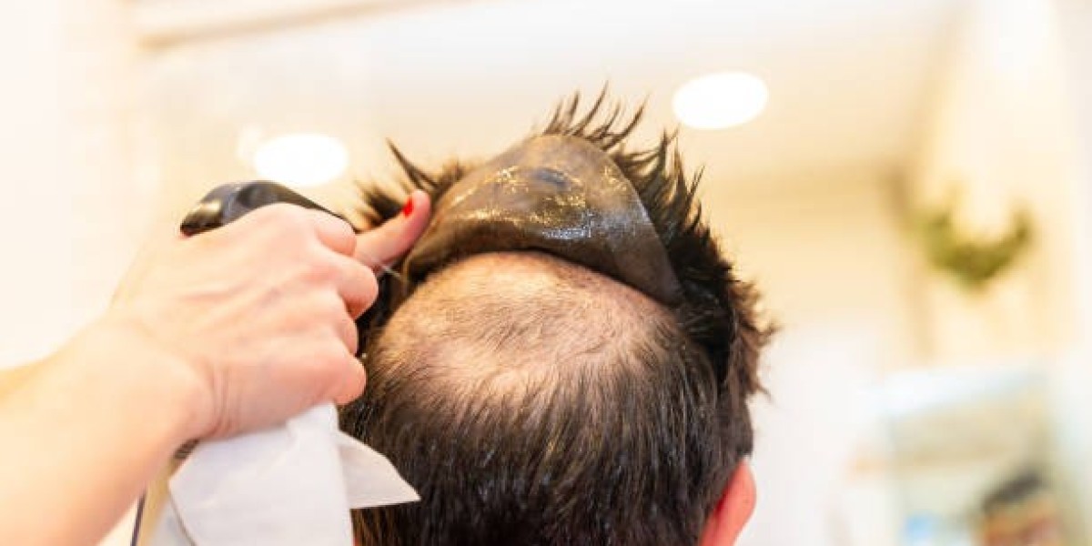 Hair Transplant in Riyadh: Costs, Results, and Tips