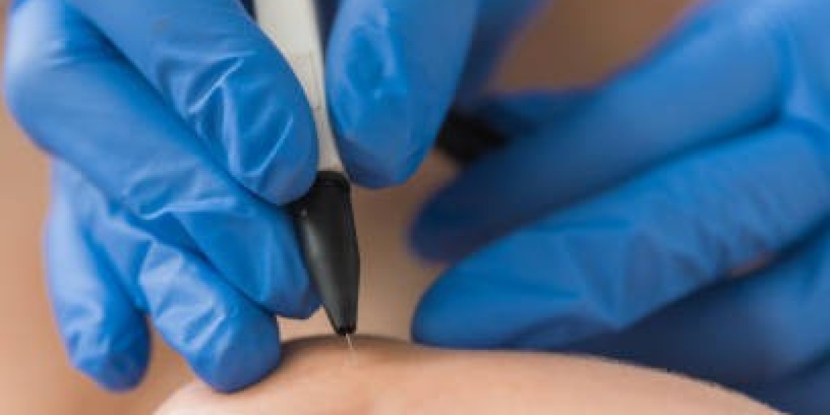 Top Benefits of Electrolysis Hair Removal in Riyadh