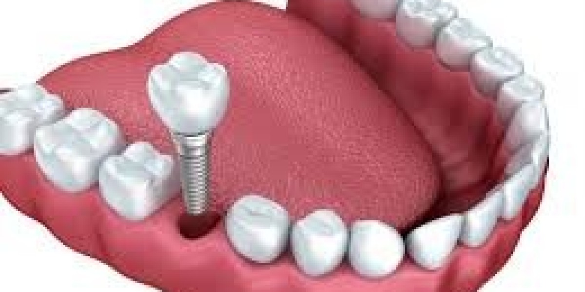 Restore Your Smile with Dental Implants in Lake Mary