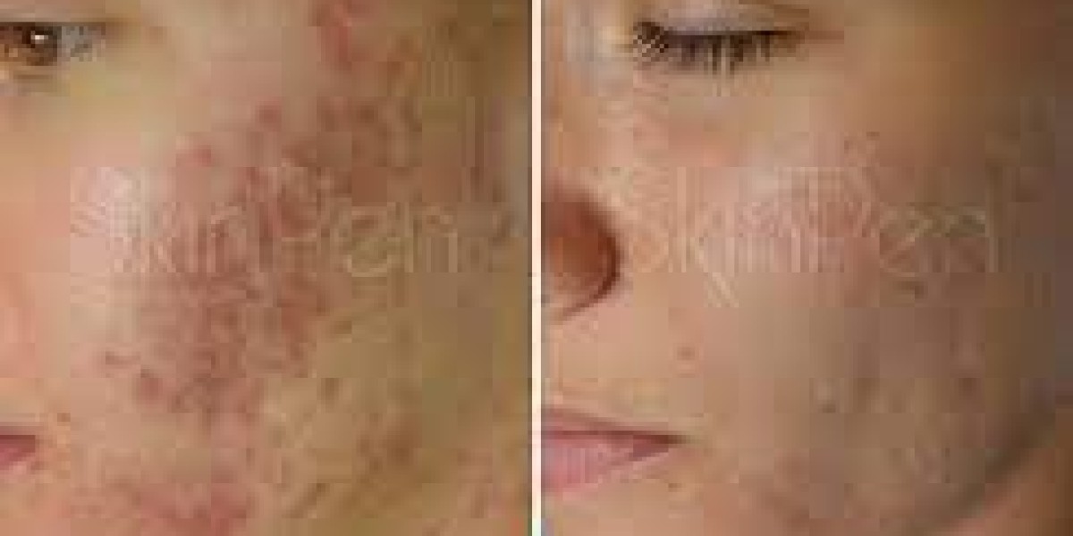 Why Peshawar Residents Trust Microneedling for Acne Scars