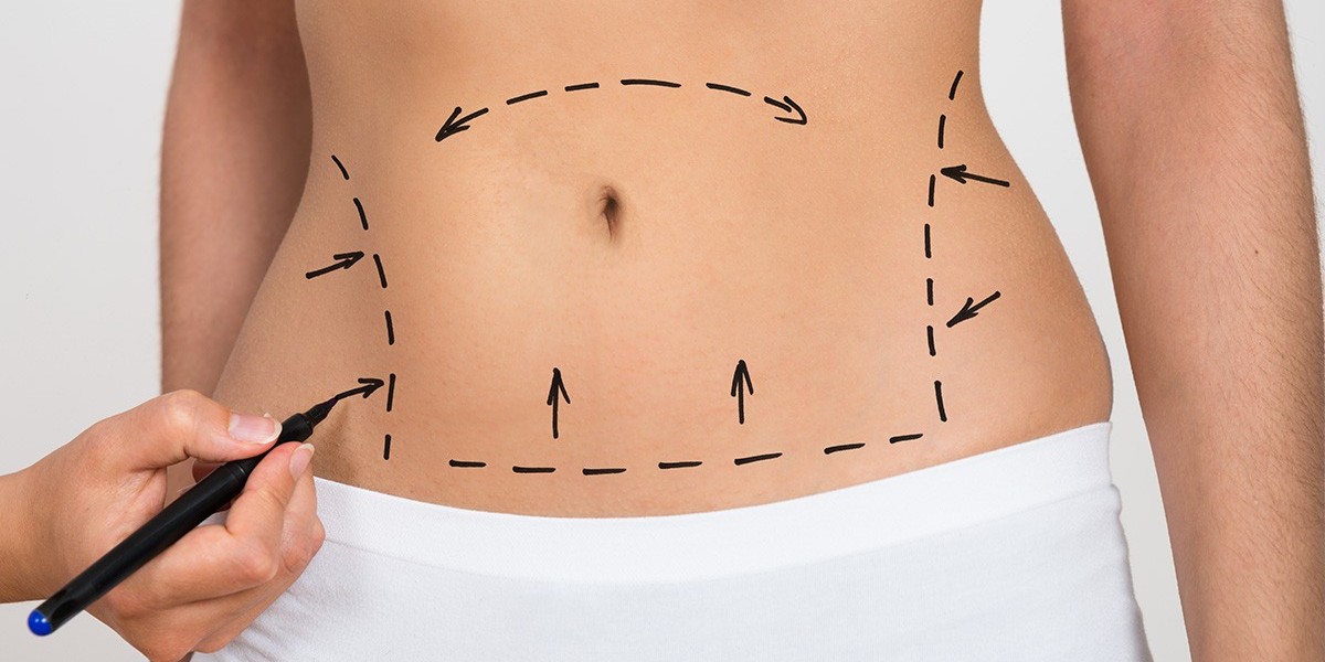 The History and Evolution of Liposuction
