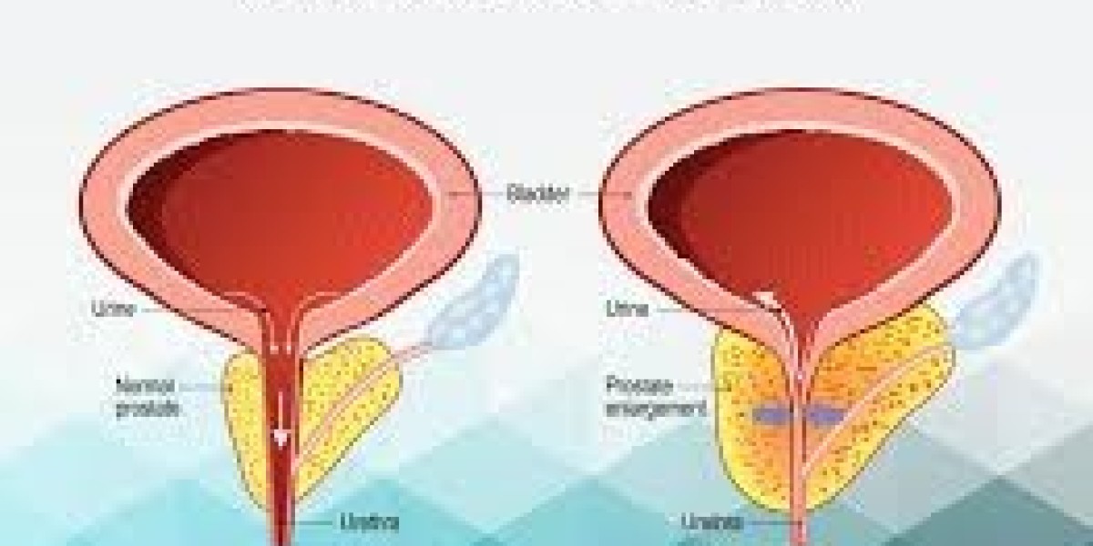 Understanding Benign Prostatic Hyperplasia (BPH): Symptoms, Causes, and Treatment