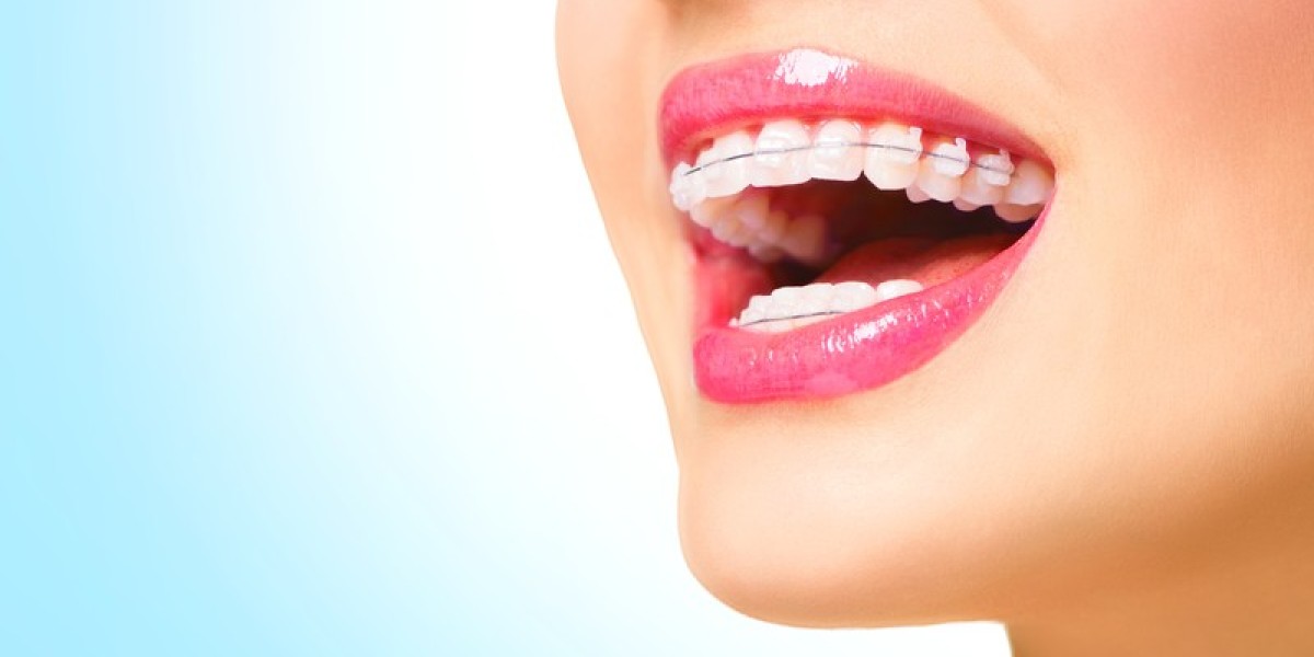 The Rise of Luxury Orthodontics in Dubai: What Sets It Apart