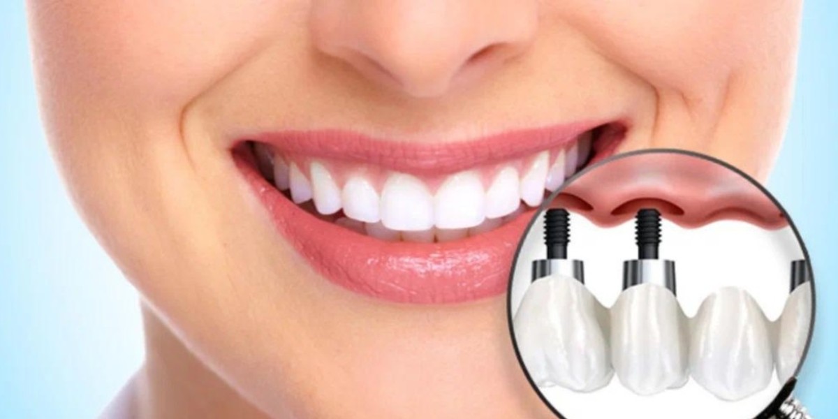 Speak and Eat Without Worry with Dental Implants Dubai