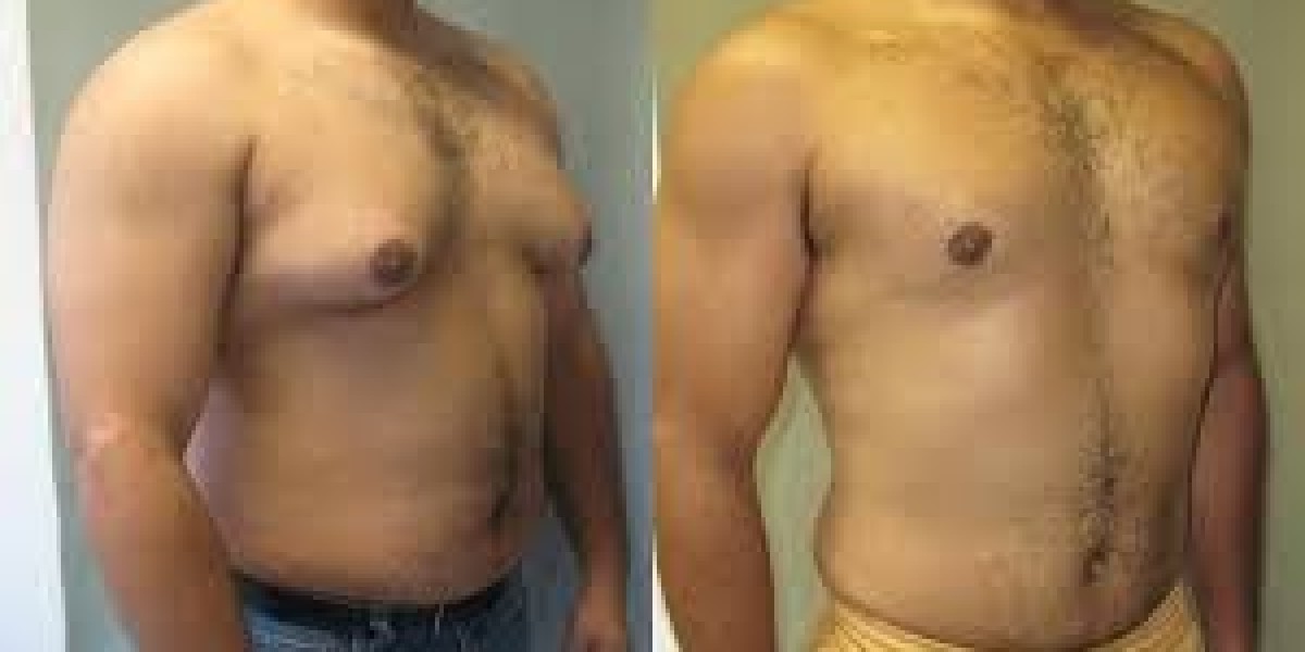 Gynecomastia Surgery Cost: A Complete Guide