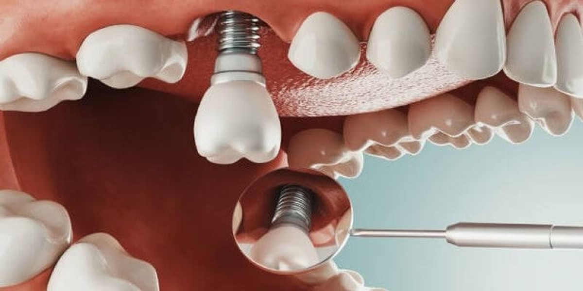 Trồng răng implant miễn phí – Sự thật hay chiêu trò quảng cáo? Tìm hiểu chi tiết để không mất tiền oan
