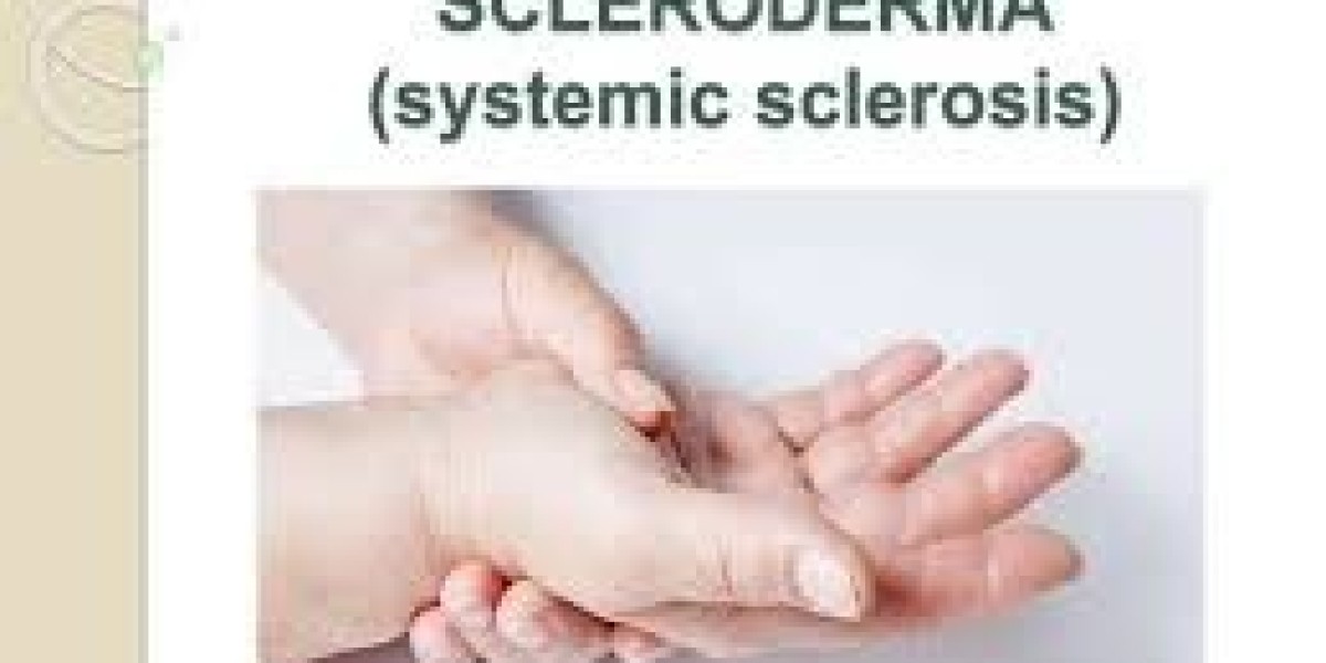 Emerging Trends in Global Systemic Scleroderma Treatment Market Forecast to 2030 – 2025