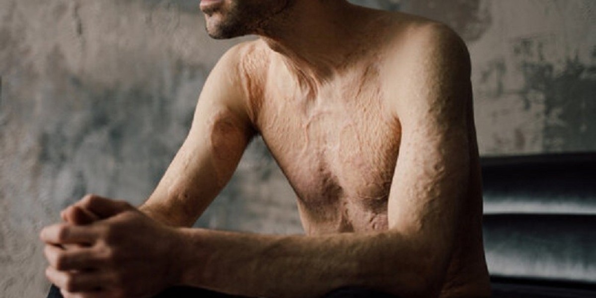 Preparing for reconstructive burn surgery