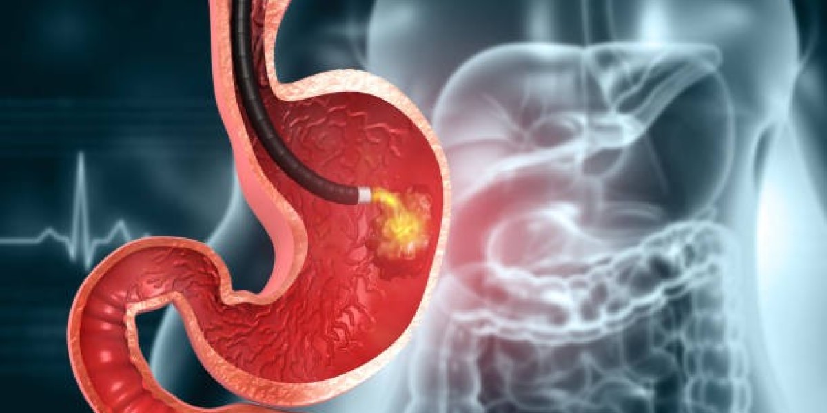 Expert Gastric Balloon Riyadh: A Non-Surgical Path to Weight Loss