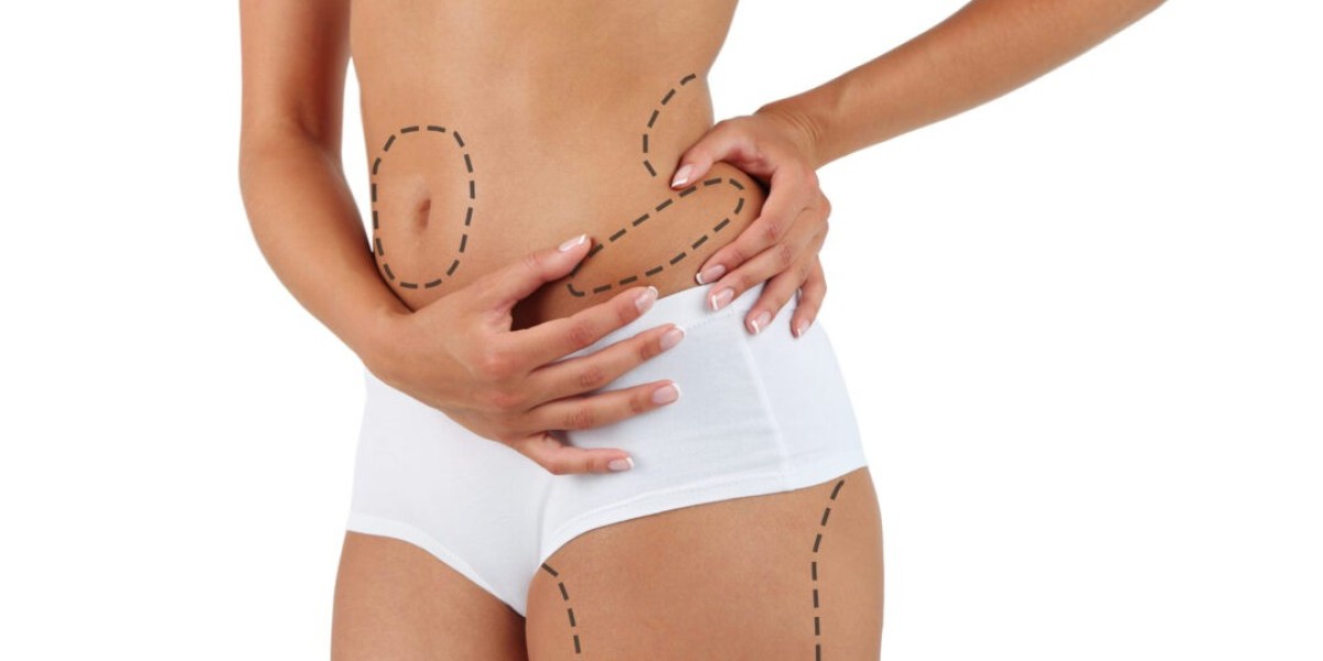 Liposuction in Islamabad vs. Non-Surgical Fat Removal – Which Is Better?