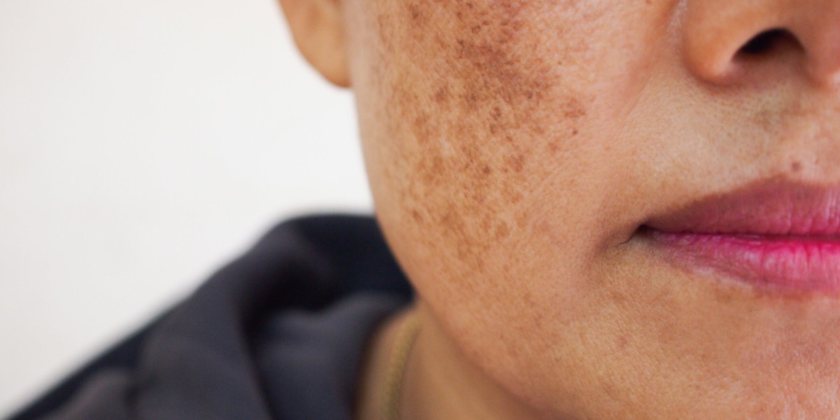 Melasma Treatment in Dubai: Tips Before Your First Visit