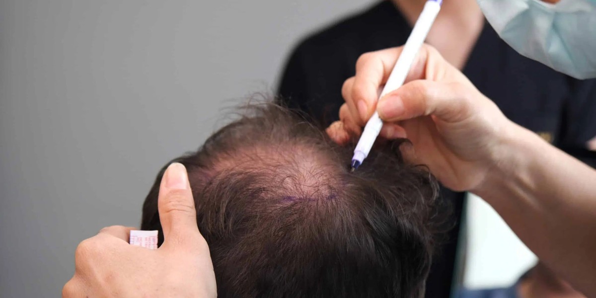 Hair Transplant in Dubai for Stronger Style Statements