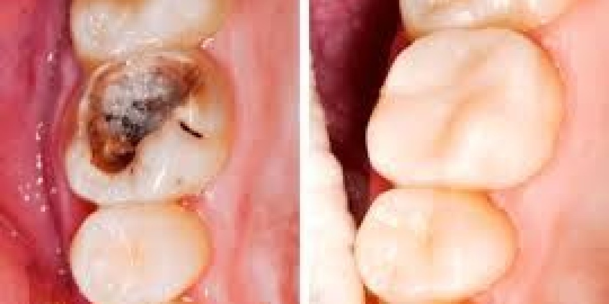 Trám răng sâu lỗ to bao nhiêu tiền? Bảng giá mới & Lưu ý cần biết