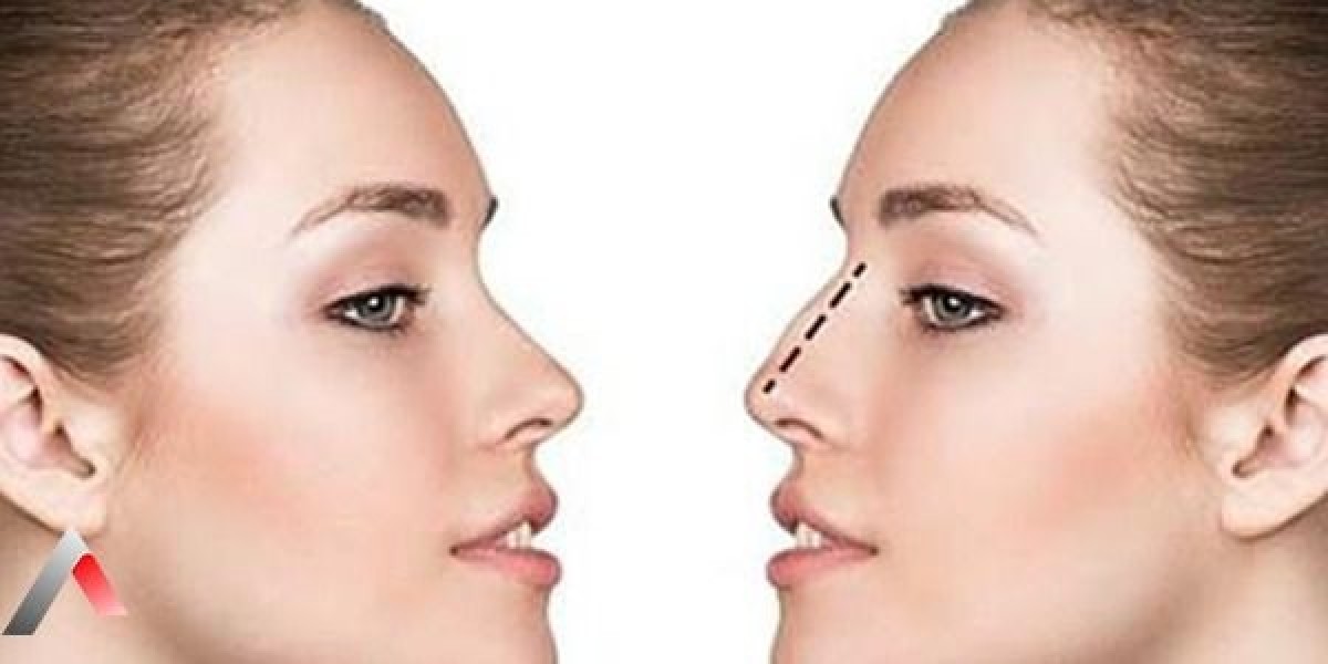 استخدام التقنيات الحديثة في تجميل الأنف