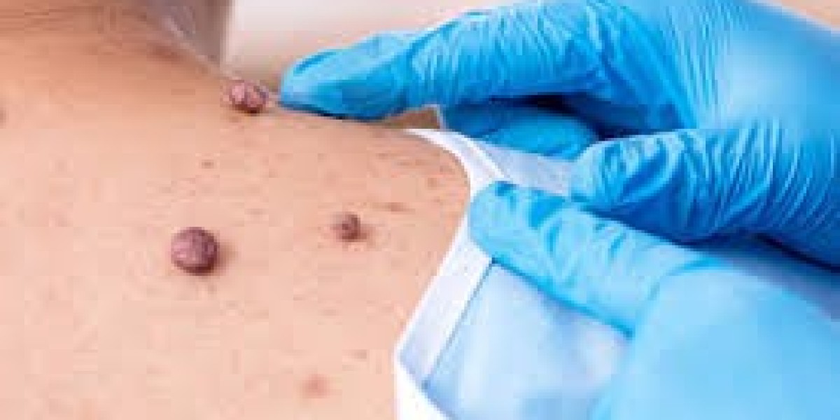 Different Methods of Mole Removal in Dubai Explained